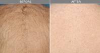 Chicago Laser Hair Removal